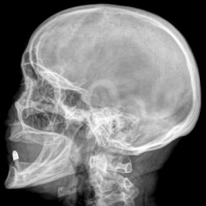 Röntgenbild des Kopfes