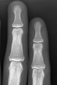 kein Verschleiß normale Finger