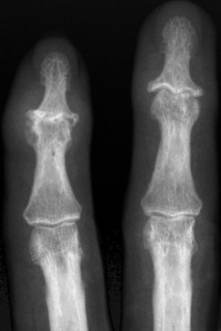 schwere Heberdenarthrose Heberdenarthrose
