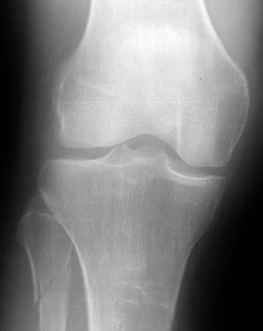 Knie Knie-Fraktur