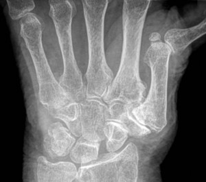 Daumenfehlstellung bei Arthrose